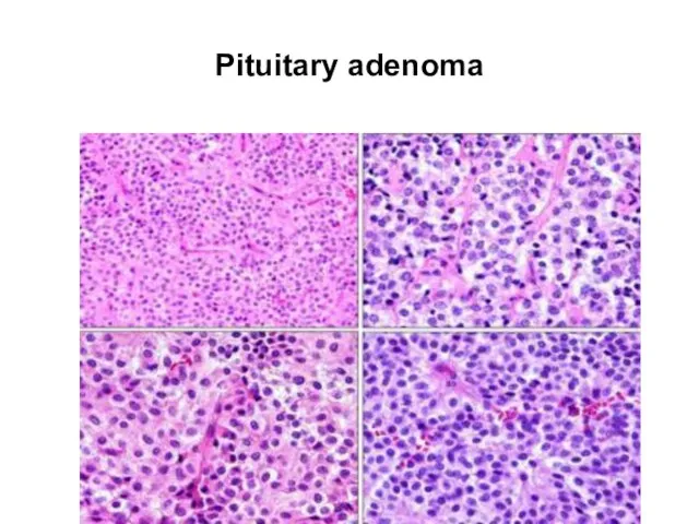 Pituitary adenoma