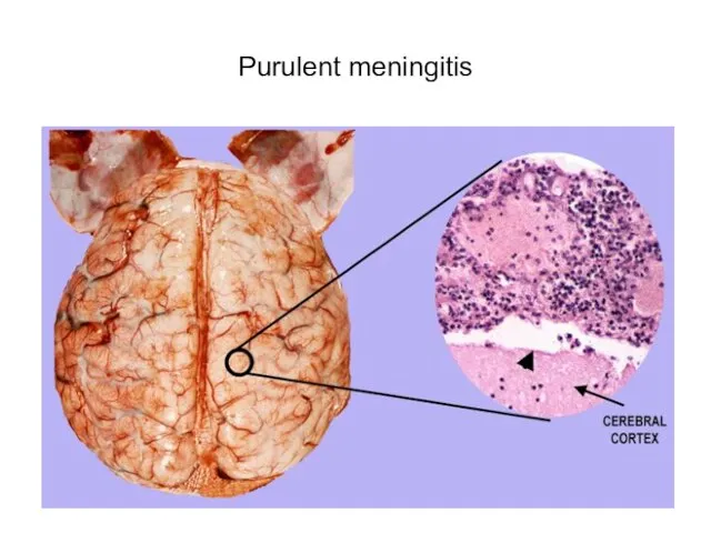 Purulent meningitis