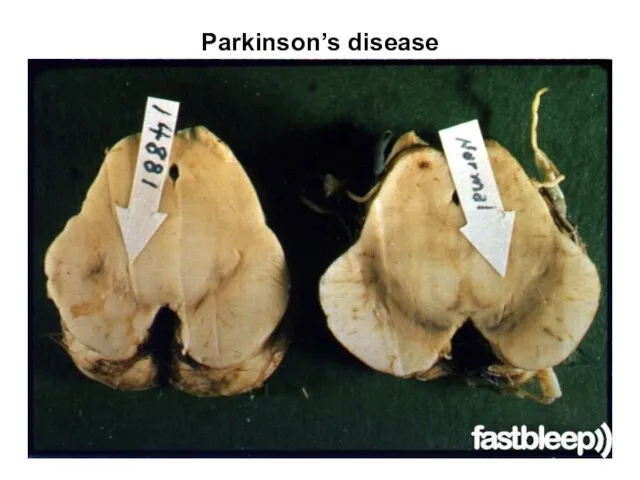 Parkinson’s disease