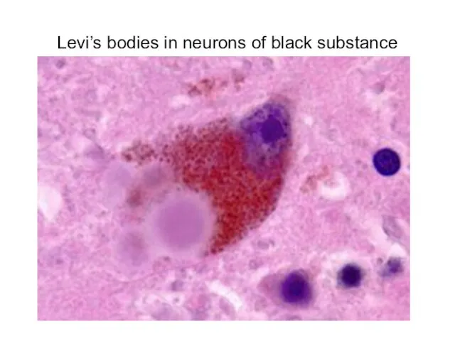 Levi’s bodies in neurons of black substance