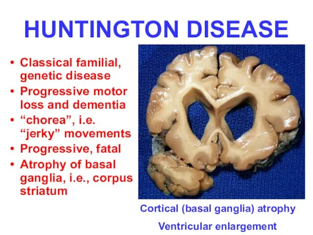 HUNTINGTON DISEASE Classical familial, genetic disease Progressive motor loss and dementia