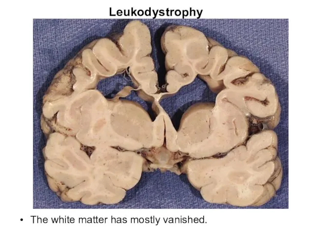 Leukodystrophy The white matter has mostly vanished.