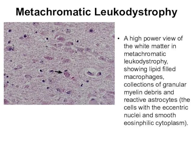 Metachromatic Leukodystrophy A high power view of the white matter in