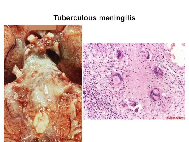 Tuberculous meningitis