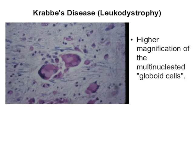 Krabbe's Disease (Leukodystrophy) Higher magnification of the multinucleated "globoid cells".