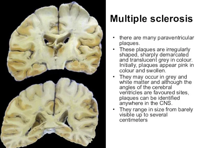 Multiple sclerosis there are many paraventricular plaques. These plaques are irregularly