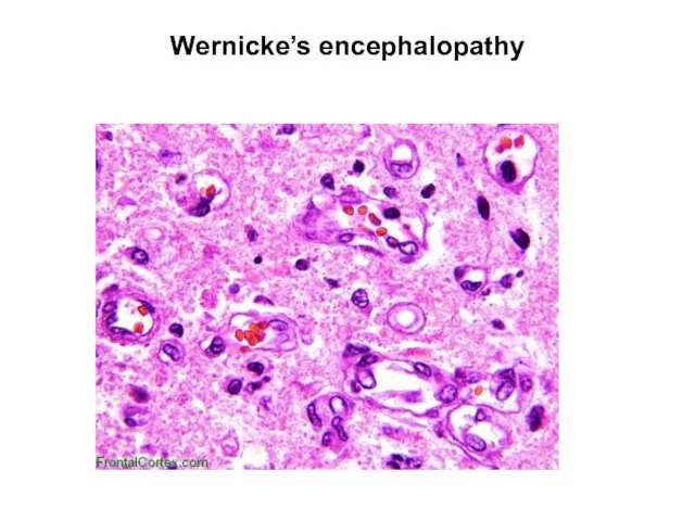 Wernicke’s encephalopathy