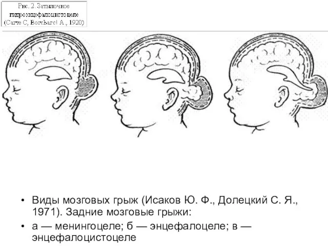 Виды мозговых грыж (Исаков Ю. Ф., Долецкий С. Я., 1971). Задние