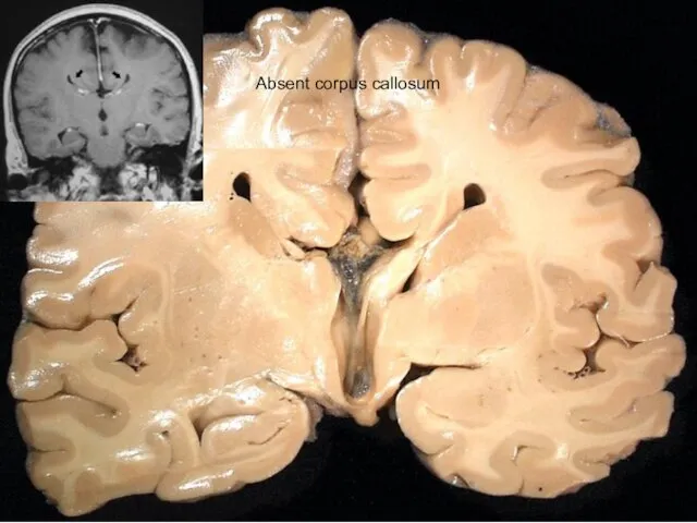 Absent corpus callosum