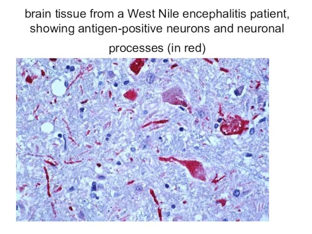 brain tissue from a West Nile encephalitis patient, showing antigen-positive neurons and neuronal processes (in red)