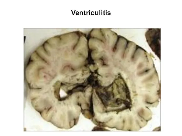 Ventriculitis