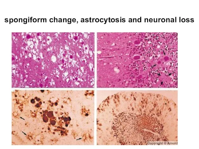 spongiform change, astrocytosis and neuronal loss