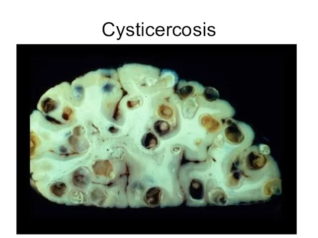 Cysticercosis