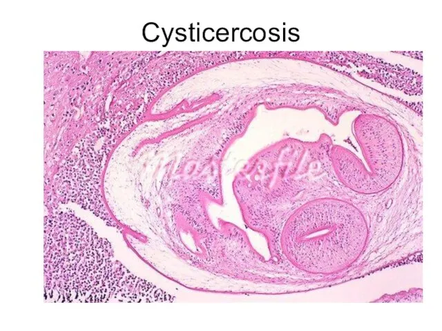 Cysticercosis