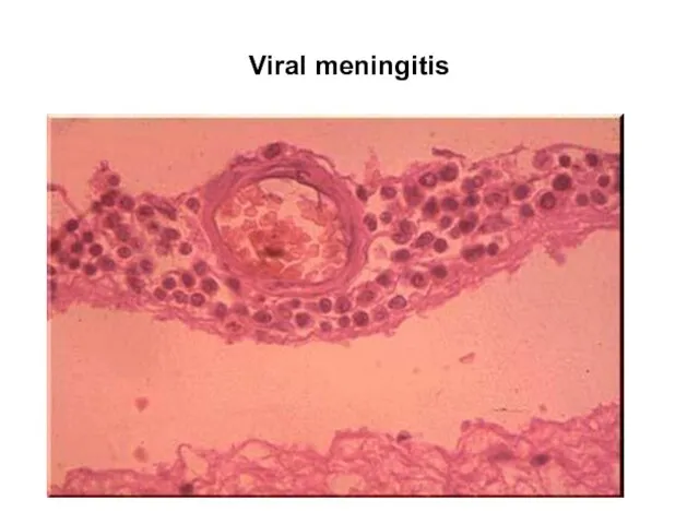 Viral meningitis