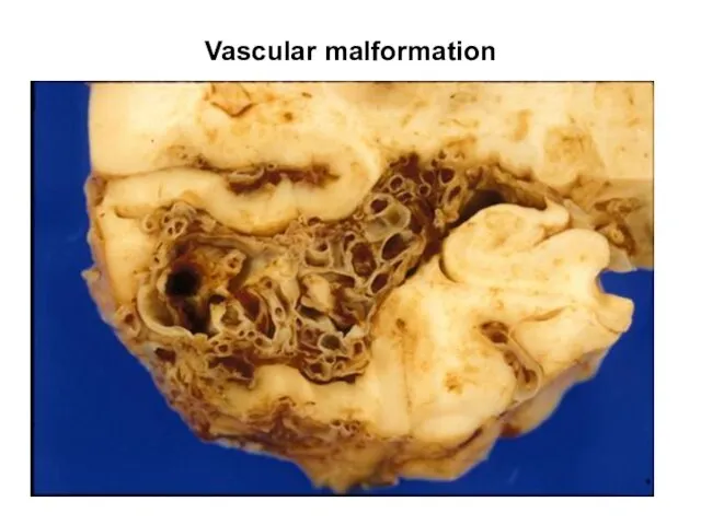 Vascular malformation