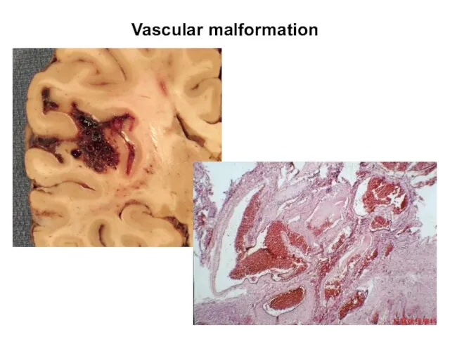 Vascular malformation