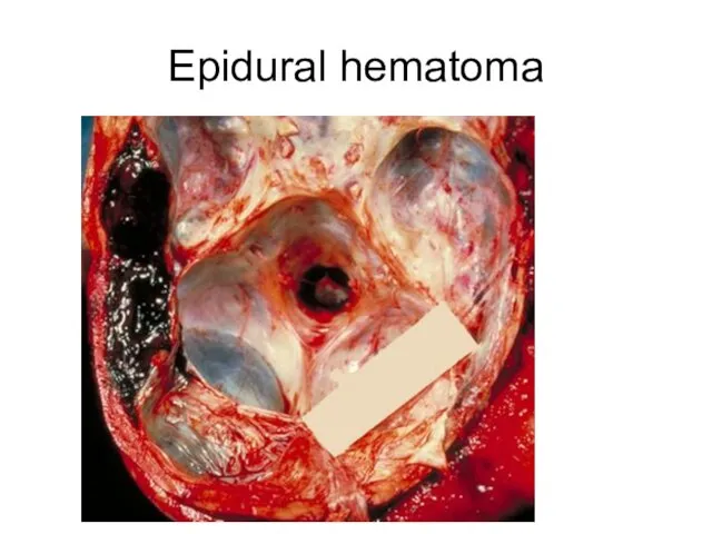 Epidural hematoma