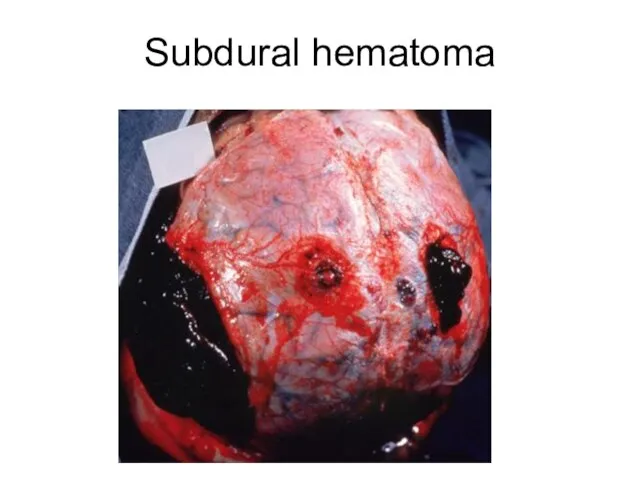 Subdural hematoma