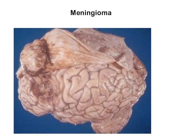 Meningioma