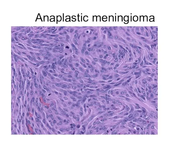 Anaplastic meningioma