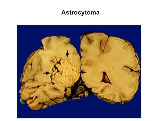 Astrocytoma