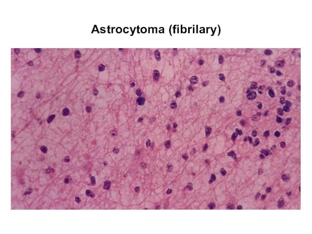 Astrocytoma (fibrilary)