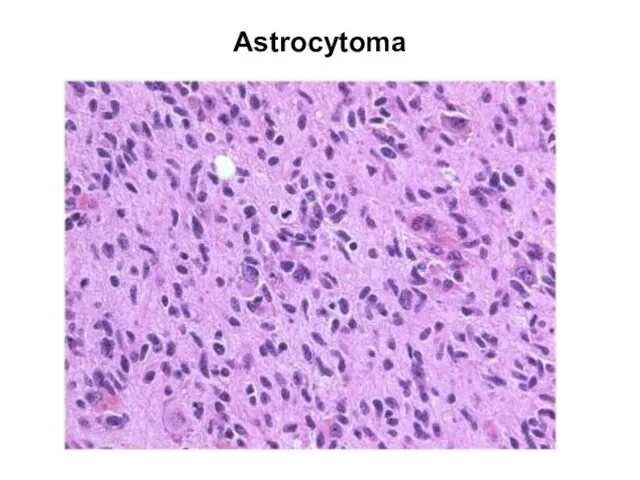 Astrocytoma