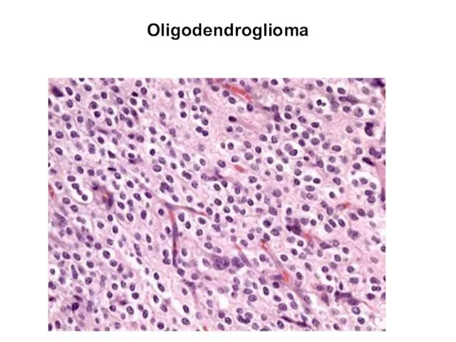 Oligodendroglioma