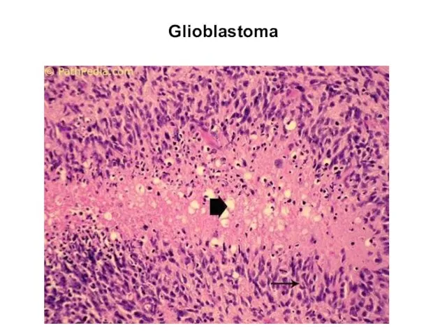 Glioblastoma