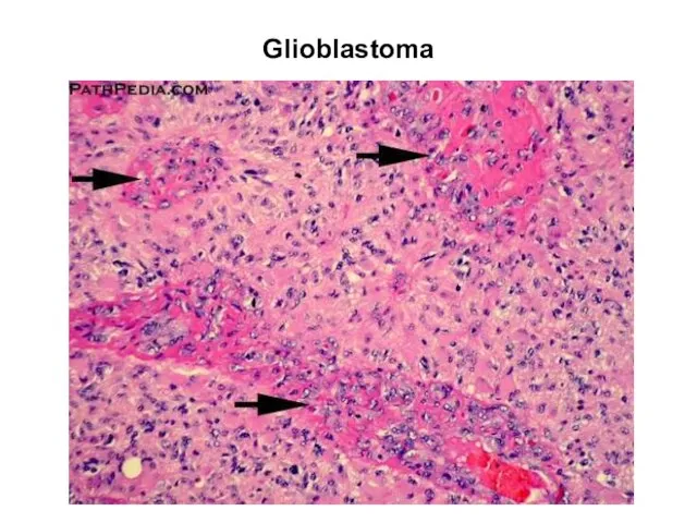 Glioblastoma