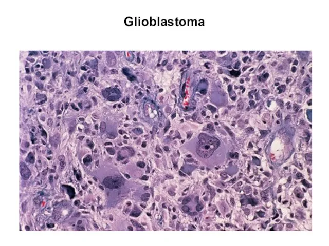 Glioblastoma