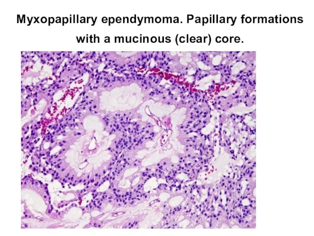 Myxopapillary ependymoma. Papillary formations with a mucinous (clear) core.