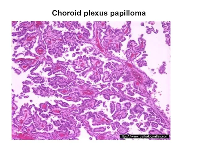 Choroid plexus papilloma