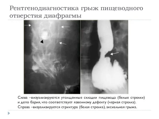 Рентгенодиагностика грыж пищеводного отверстия диафрагмы Слева –визуализируются утолщенные складки пищевода (белые