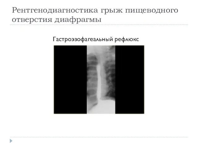 Рентгенодиагностика грыж пищеводного отверстия диафрагмы Гастроэзофагеальный рефлюкс