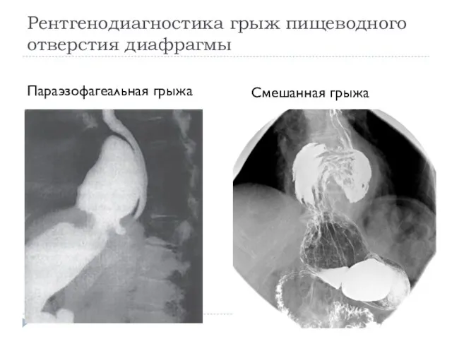 Рентгенодиагностика грыж пищеводного отверстия диафрагмы Параэзофагеальная грыжа Смешанная грыжа