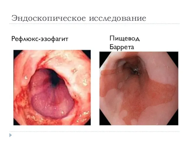 Эндоскопическое исследование Рефлюкс-эзофагит Пищевод Баррета