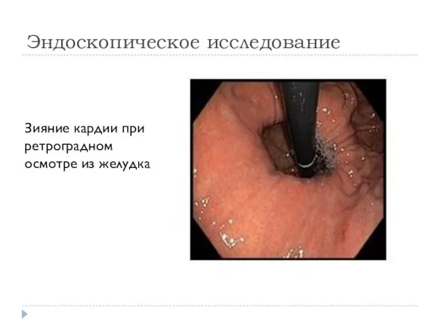 Эндоскопическое исследование Зияние кардии при ретроградном осмотре из желудка