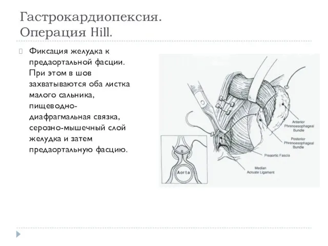 Гастрокардиопексия. Операция Hill. Фиксация желудка к предаортальной фасции. При этом в