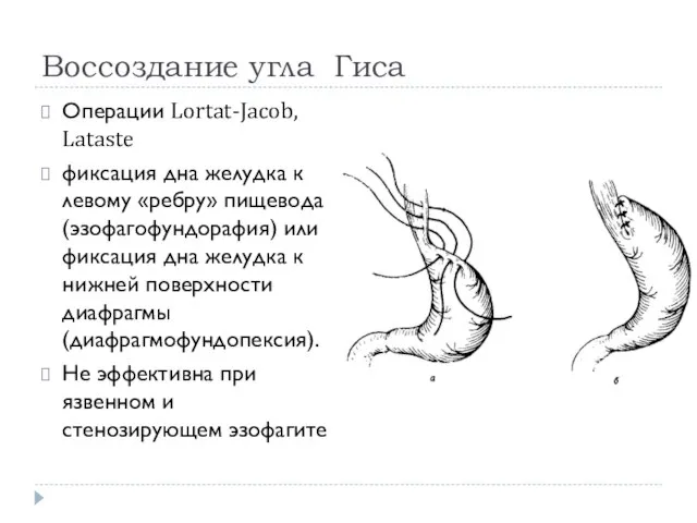 Воссоздание угла Гиса Операции Lortat-Jacob, Lataste фиксация дна желудка к левому