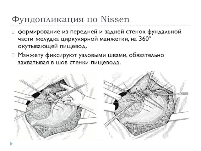 Фундопликация по Nissen формирование из передней и задней стенок фундальной части