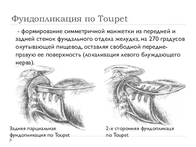 Фундопликация по Toupet - формирование симметричной манжетки из передней и задней