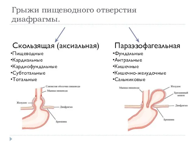 Грыжи пищеводного отверстия диафрагмы.