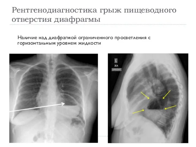 Рентгенодиагностика грыж пищеводного отверстия диафрагмы Наличие над диафрагмой ограниченного просветления с горизонтальным уровнем жидкости