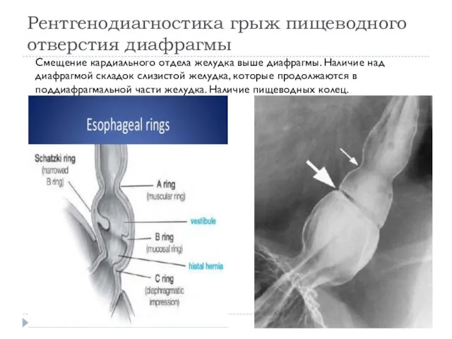 Рентгенодиагностика грыж пищеводного отверстия диафрагмы Смещение кардиального отдела желудка выше диафрагмы.