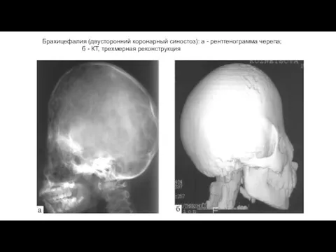 Брахицефалия (двусторонний коронарный синостоз): а - рентгенограмма черепа; б - КТ, трехмерная реконструкция