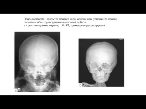 Плагиоцефалия - закрытие правого коронарного шва, уплощение правой половины лба с