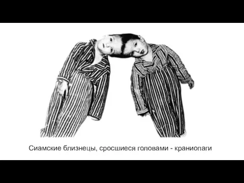 Сиамские близнецы, сросшиеся головами - краниопаги