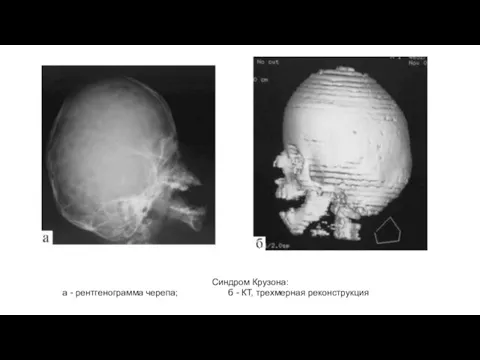 Синдром Крузона: а - рентгенограмма черепа; б - КТ, трехмерная реконструкция